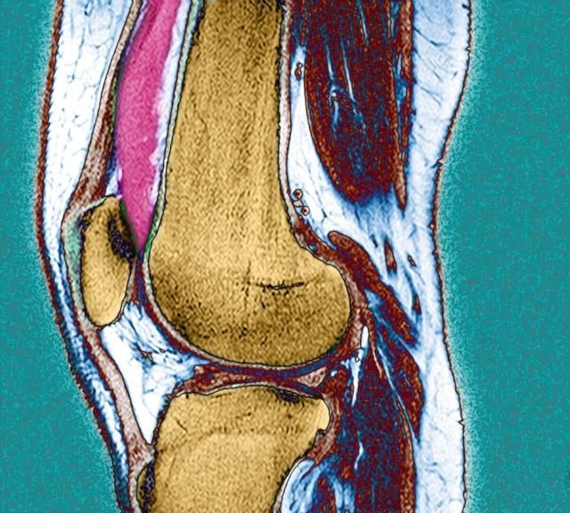 膝盖积水如何消除 膝盖积水什么原因
