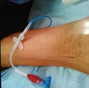 敷贴怎么撕下来 中药敷贴怎么撕